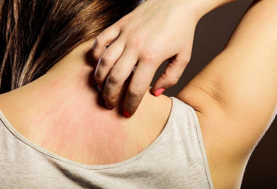 Kondisi Langka, Wanita Ini Bagikan Cerita Alergi Terhadap Air